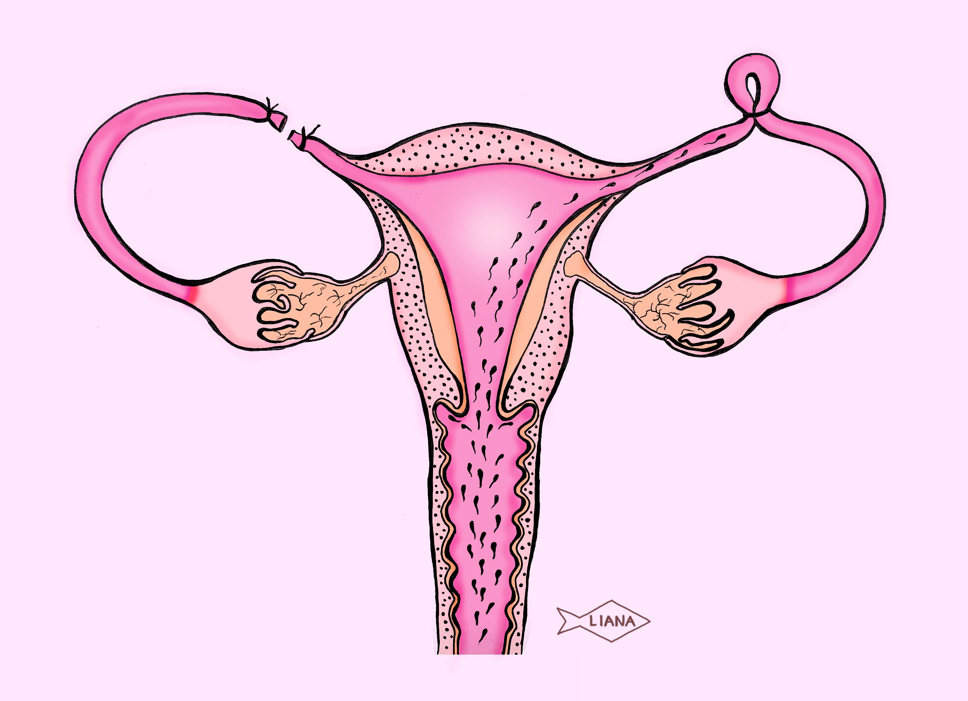 La esterilización femenina_ El método anticonceptivo más usado en Colombia